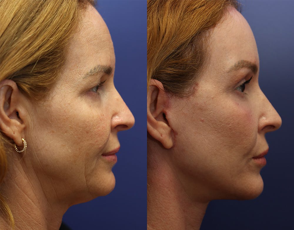 Deep Plane Facelift Before & After Gallery - Patient 149295891 - Image 4