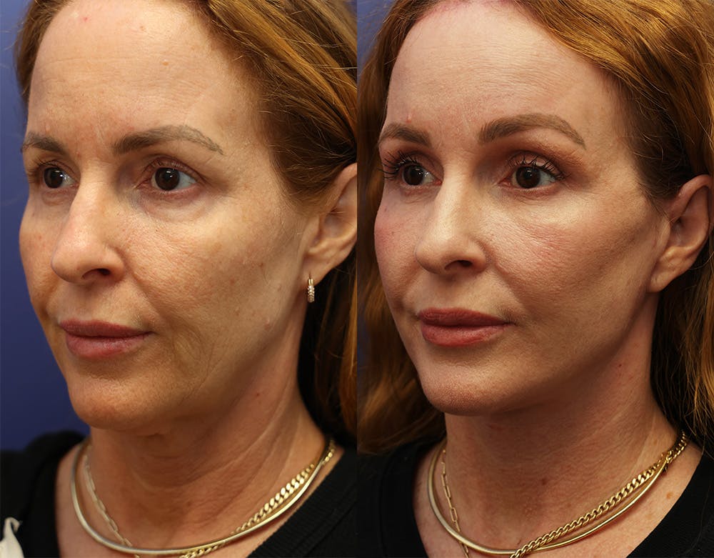 Deep Plane Facelift Before & After Gallery - Patient 149295891 - Image 3