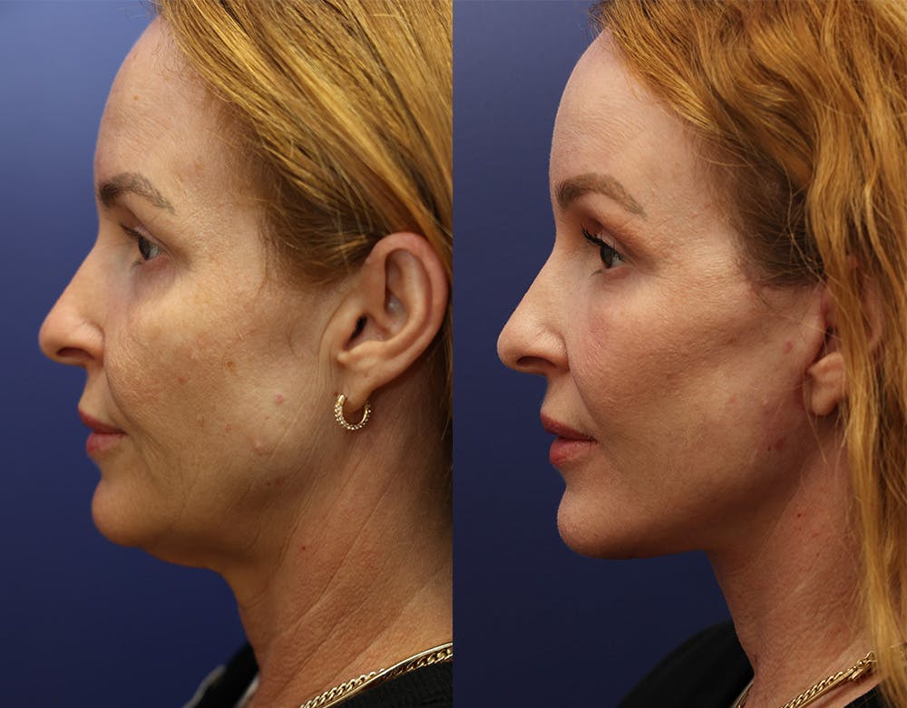 Deep Plane Facelift Before & After Gallery - Patient 149295891 - Image 5