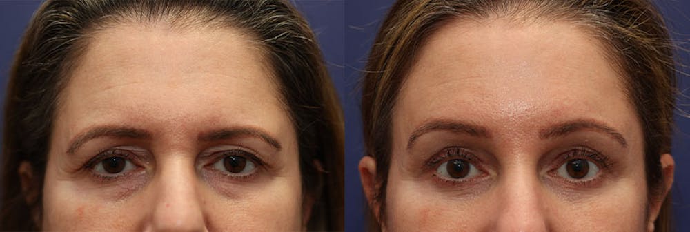Brow Lift (Forehead Lift) Before & After Gallery - Patient 161307672 - Image 1