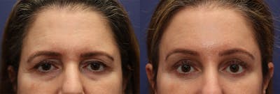 Eyelid Surgery Before & After Gallery - Patient 161307644 - Image 1