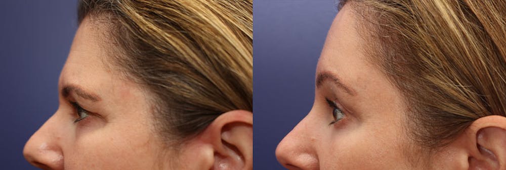 Eyelid Surgery Before & After Gallery - Patient 161307644 - Image 2