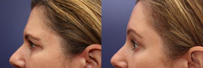 Eyelid Surgery Before & After Gallery - Patient 161307644 - Image 2