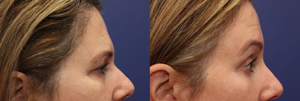 Brow Lift (Forehead Lift) Before & After Gallery - Patient 161307672 - Image 3