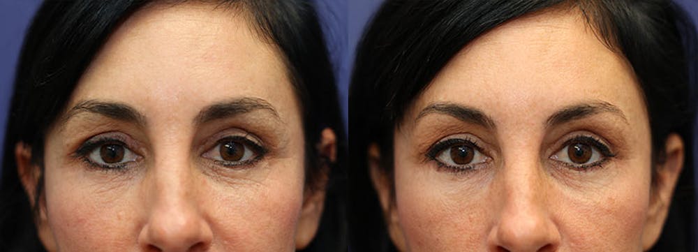 Eyelid Surgery Before & After Gallery - Patient 161307682 - Image 1