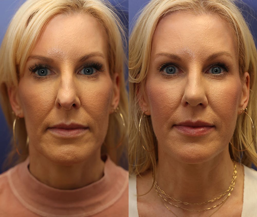 Rhinoplasty (Nose Reshaping) Before & After Gallery - Patient 161307698 - Image 5