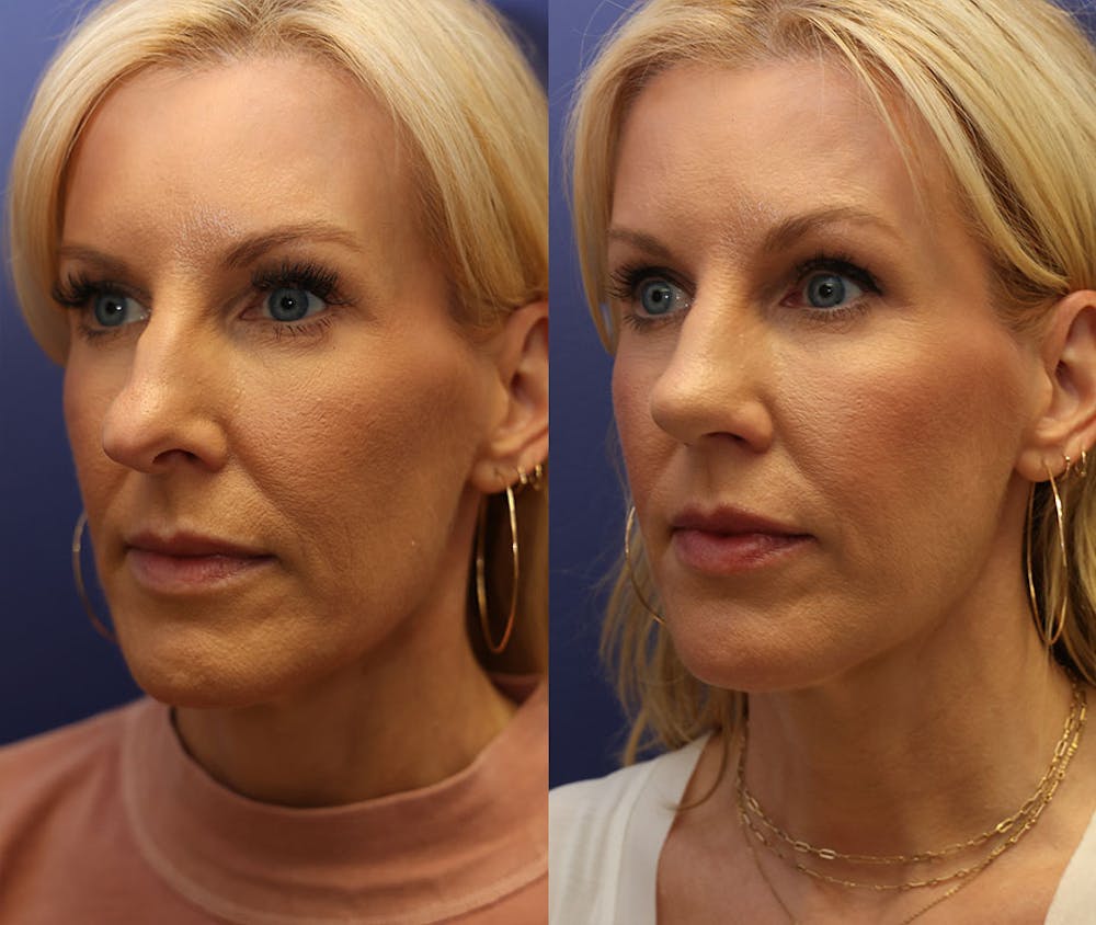 Rhinoplasty (Nose Reshaping) Before & After Gallery - Patient 161307698 - Image 2