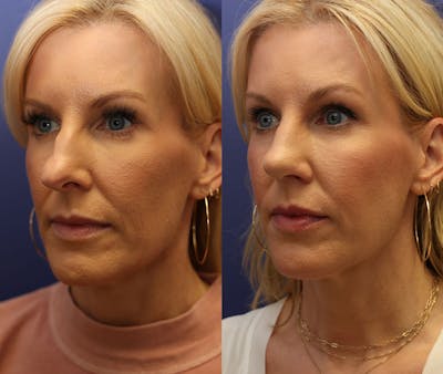 Rhinoplasty (Nose Reshaping) Before & After Gallery - Patient 161307698 - Image 2