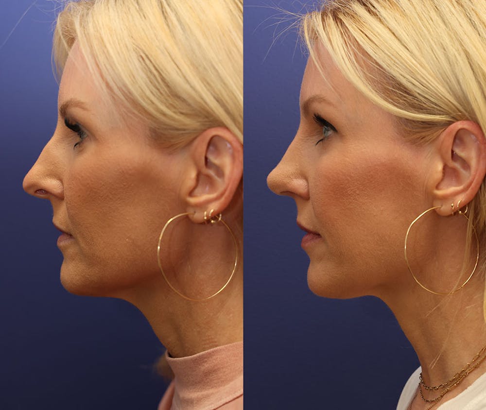 Rhinoplasty (Nose Reshaping) Before & After Gallery - Patient 161307698 - Image 3