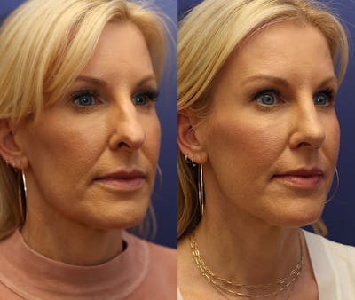 Rhinoplasty (Nose Reshaping) Before & After Gallery - Patient 161307698 - Image 1