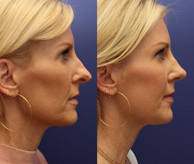 Rhinoplasty (Nose Reshaping) Before & After Gallery - Patient 161307698 - Image 4