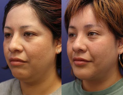 Chin Augmentation Before & After Gallery - Patient 161307721 - Image 2