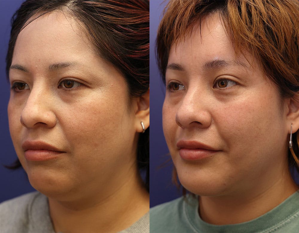 Chin Augmentation Before & After Gallery - Patient 161307721 - Image 2