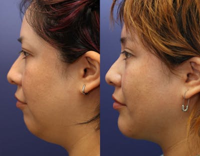 Liposuction Before & After Gallery - Patient 161307719 - Image 1