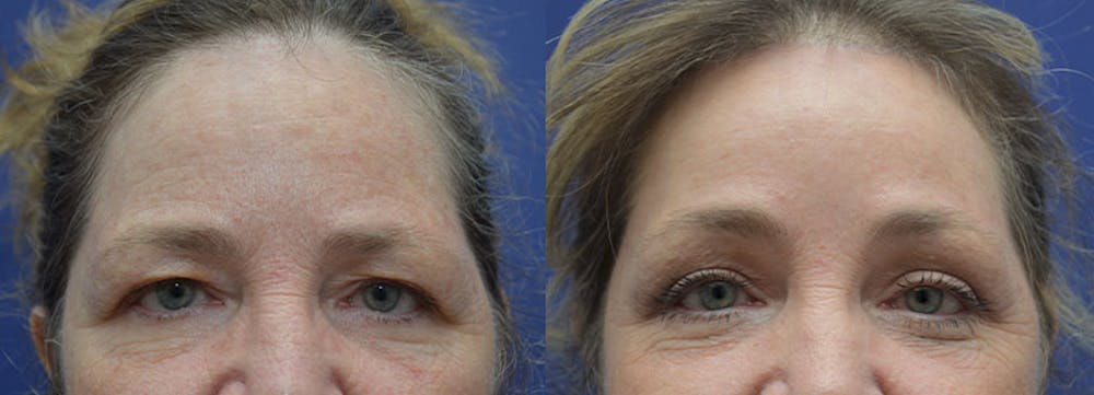 Eyelid Surgery Before & After Gallery - Patient 161307758 - Image 1