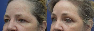 Brow Lift (Forehead Lift) Before & After Gallery - Patient 161307760 - Image 2