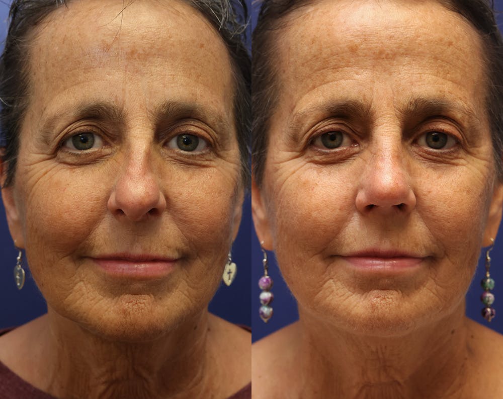 Rhinoplasty (Nose Reshaping) Before & After Gallery - Patient 175171313 - Image 4