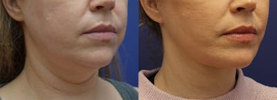 Facial Revolumizing (Fat Transfer) Before & After Gallery - Patient 175171319 - Image 2