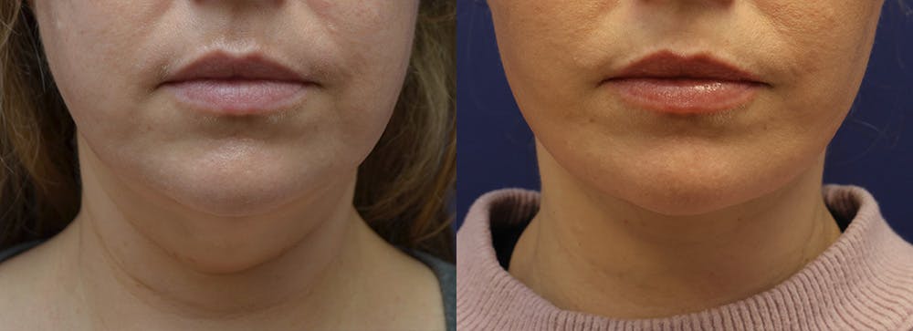 Deep Plane Neck Lift Before & After Gallery - Patient 175171318 - Image 5