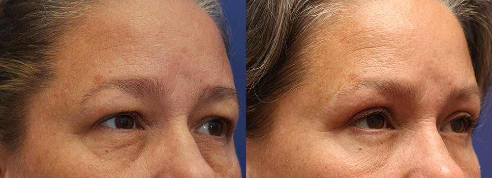 Facial Revolumizing (Fat Transfer) Before & After Gallery - Patient 175171328 - Image 3