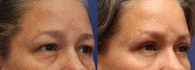 Eyelid Surgery Before & After Gallery - Patient 175171323 - Image 2