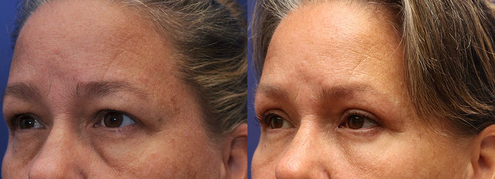 Facial Revolumizing (Fat Transfer) Before & After Gallery - Patient 175171328 - Image 2