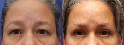 Facial Revolumizing (Fat Transfer) Before & After Gallery - Patient 175171328 - Image 1