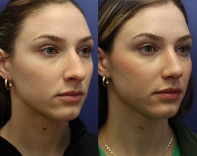 Rhinoplasty (Nose Reshaping) Before & After Gallery - Patient 175171333 - Image 1