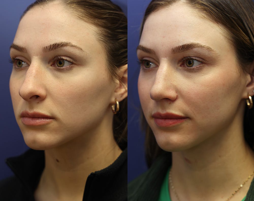 Rhinoplasty (Nose Reshaping) Before & After Gallery - Patient 175171333 - Image 3