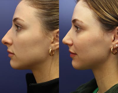 Rhinoplasty (Nose Reshaping) Before & After Gallery - Patient 175171333 - Image 4