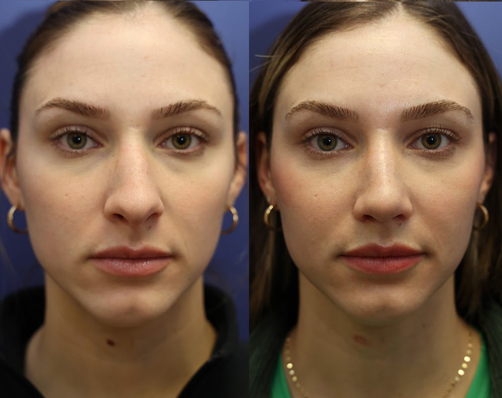 Rhinoplasty (Nose Reshaping) Before & After Gallery - Patient 175171333 - Image 2