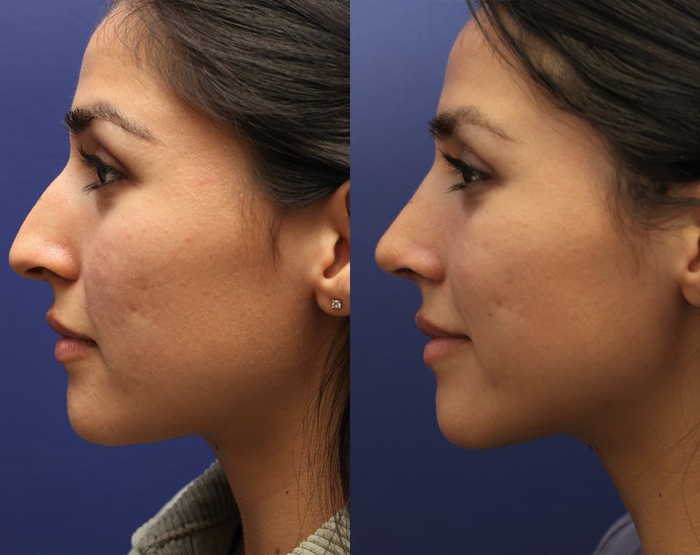 Rhinoplasty (Nose Reshaping) Before & After Gallery - Patient 175171340 - Image 3