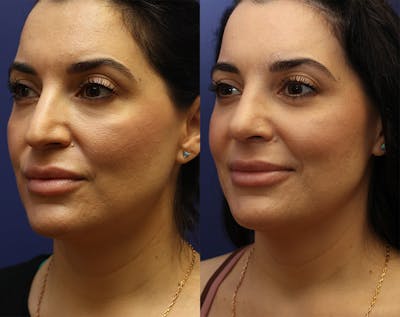 Rhinoplasty (Nose Reshaping) Before & After Gallery - Patient 179378815 - Image 1