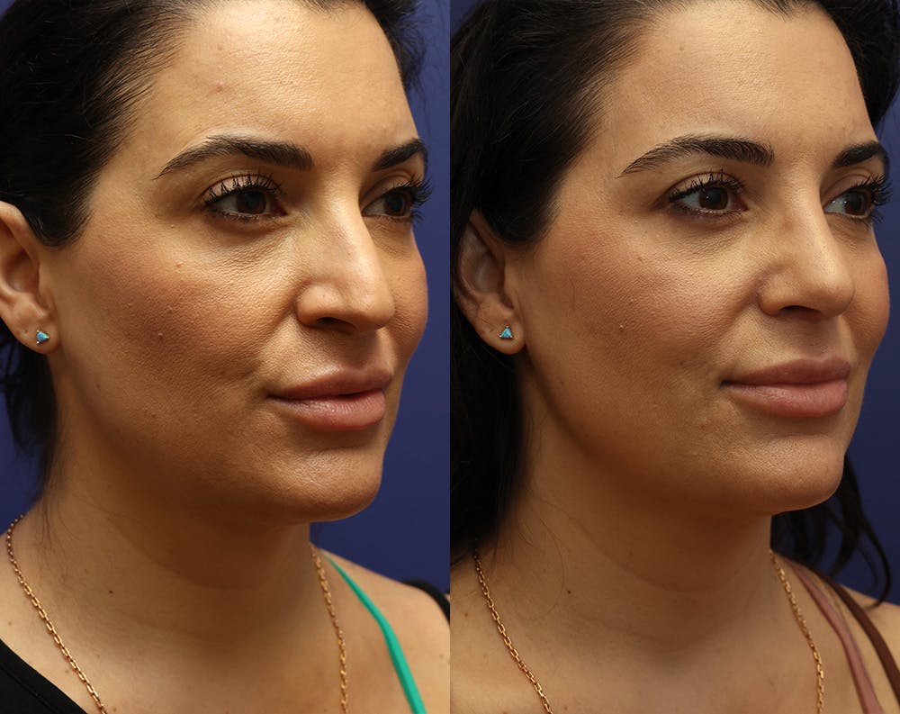 Rhinoplasty (Nose Reshaping) Before & After Gallery - Patient 179378815 - Image 3