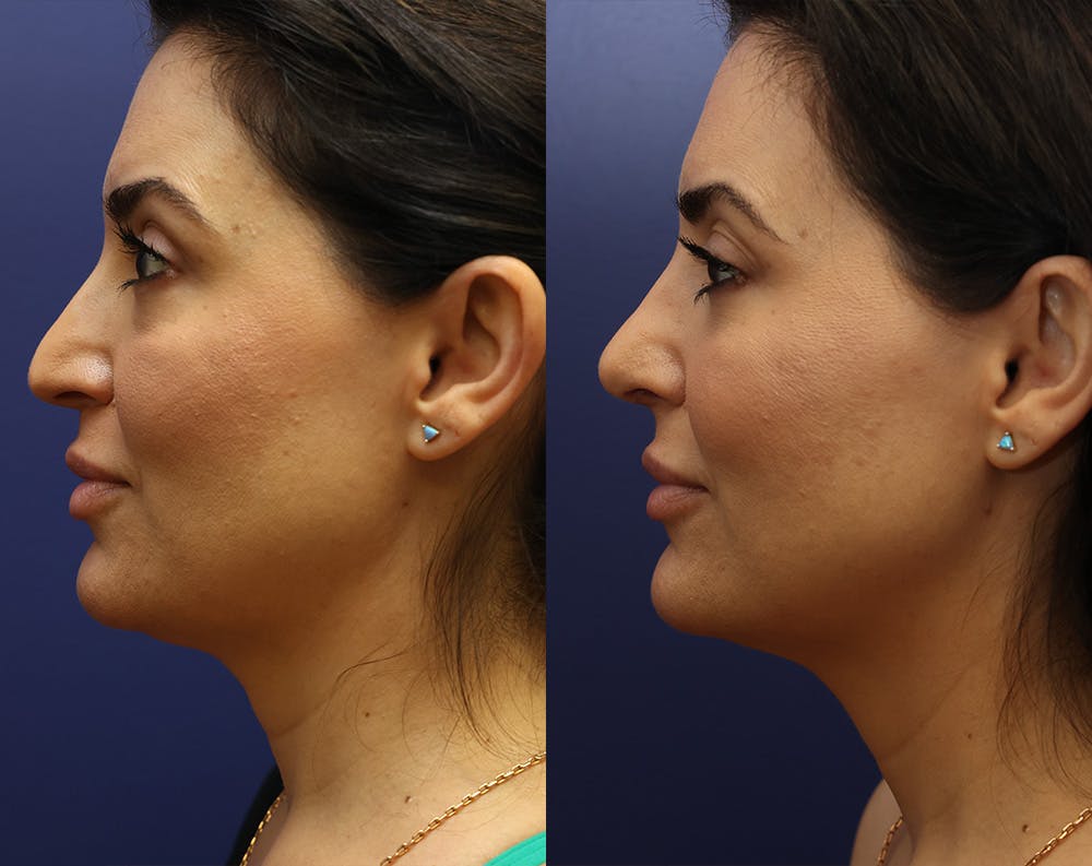Rhinoplasty (Nose Reshaping) Before & After Gallery - Patient 179378815 - Image 2