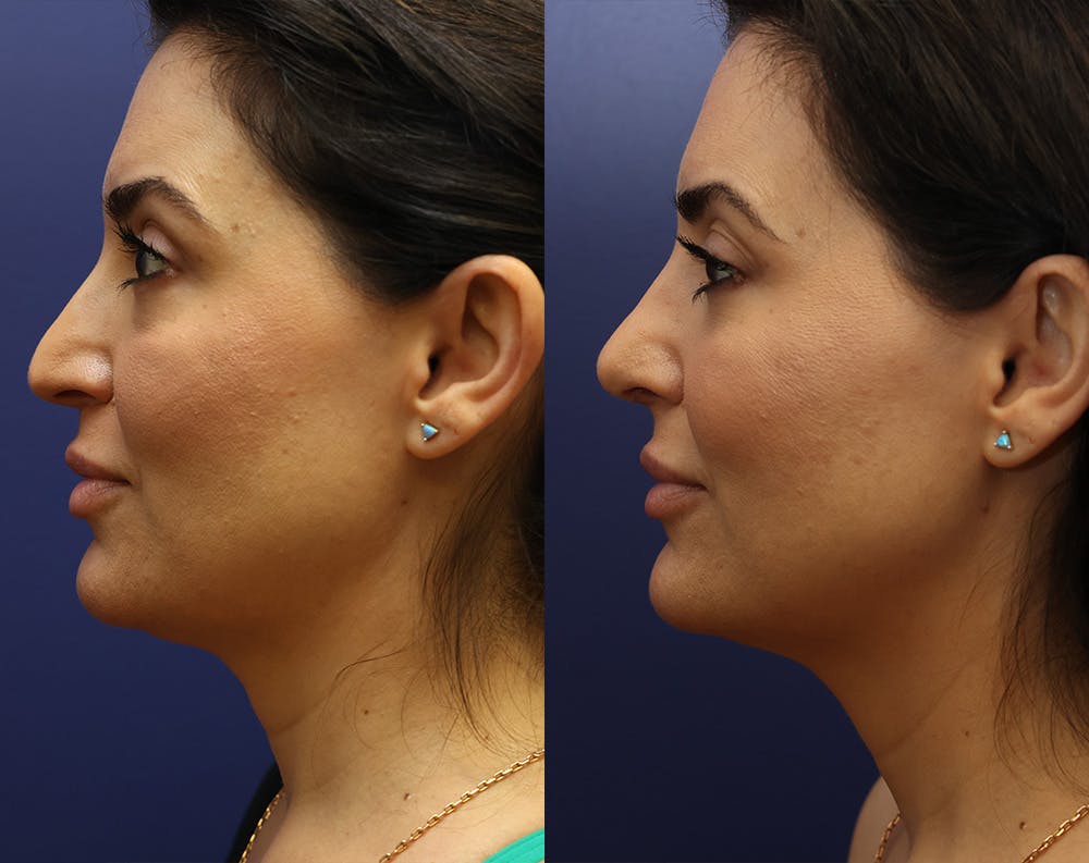 Rhinoplasty (Nose Reshaping) Before & After Gallery - Patient 179378815 - Image 1
