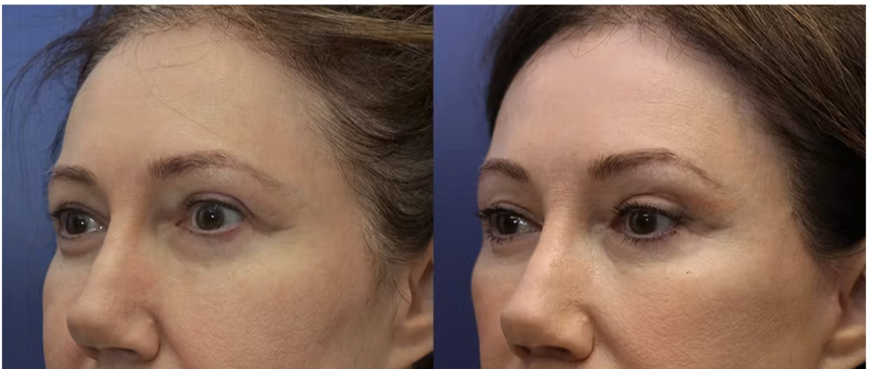 Before and after image of patient who received a brow lift