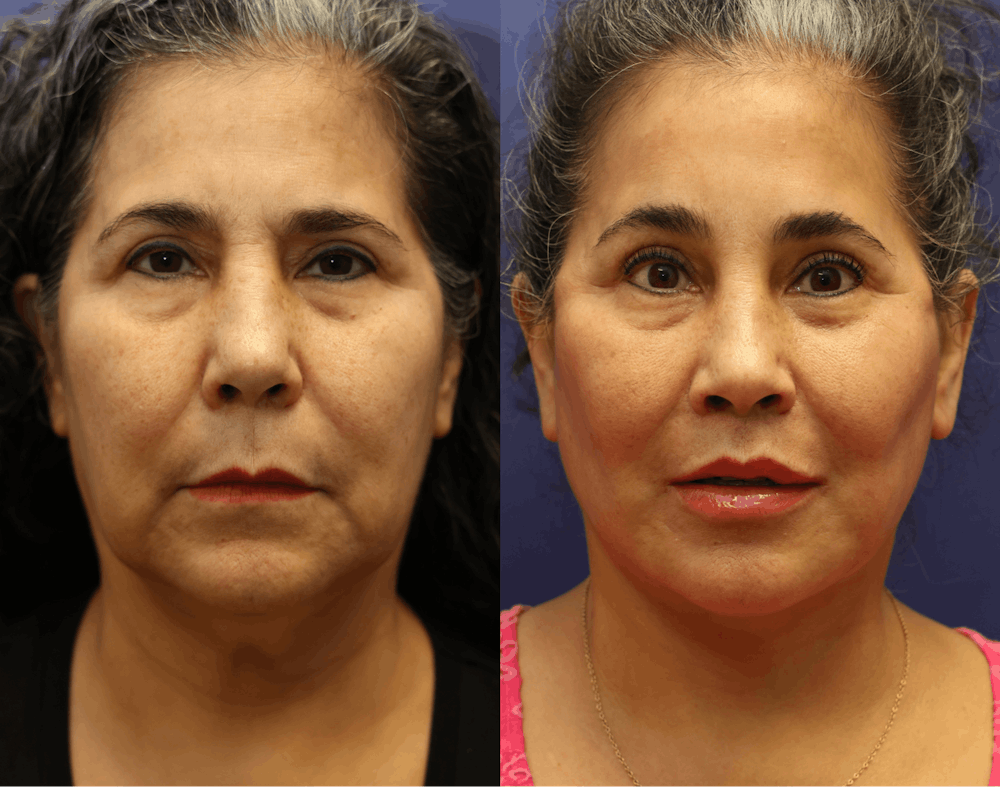 Deep Plane Facelift Before & After Gallery - Patient 708763 - Image 1