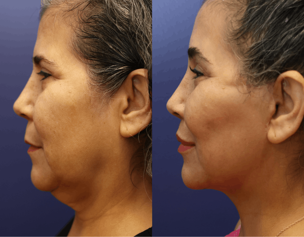 Deep Plane Facelift Before & After Gallery - Patient 708763 - Image 3