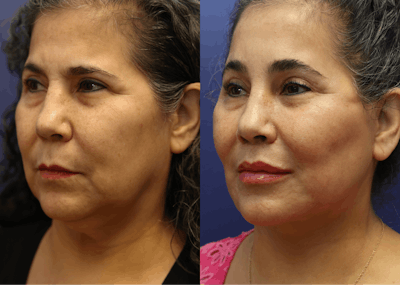 Deep Plane Facelift Before & After Gallery - Patient 708763 - Image 4