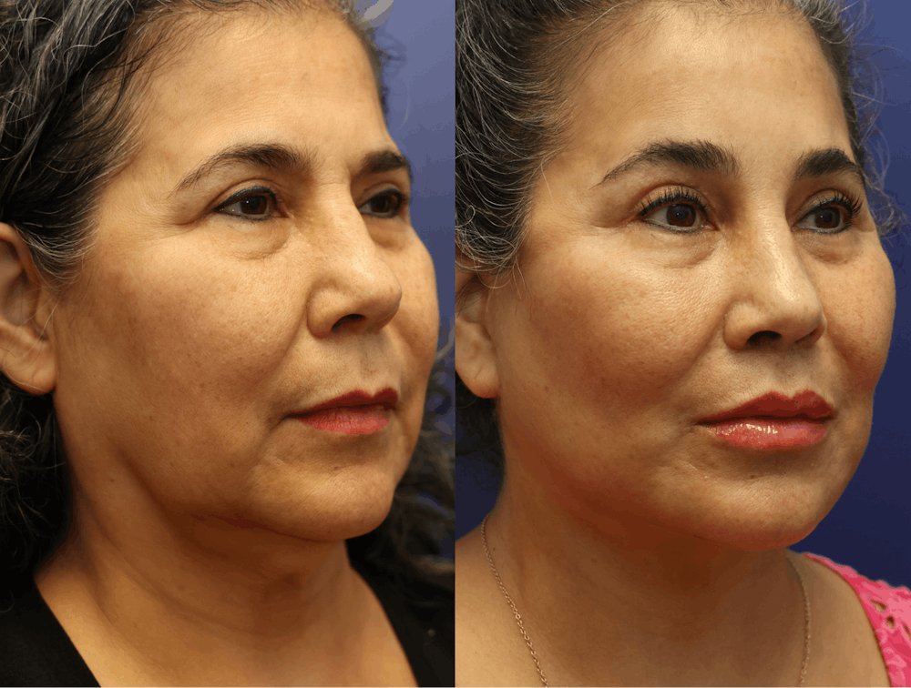 Deep Plane Facelift Before & After Gallery - Patient 708763 - Image 2