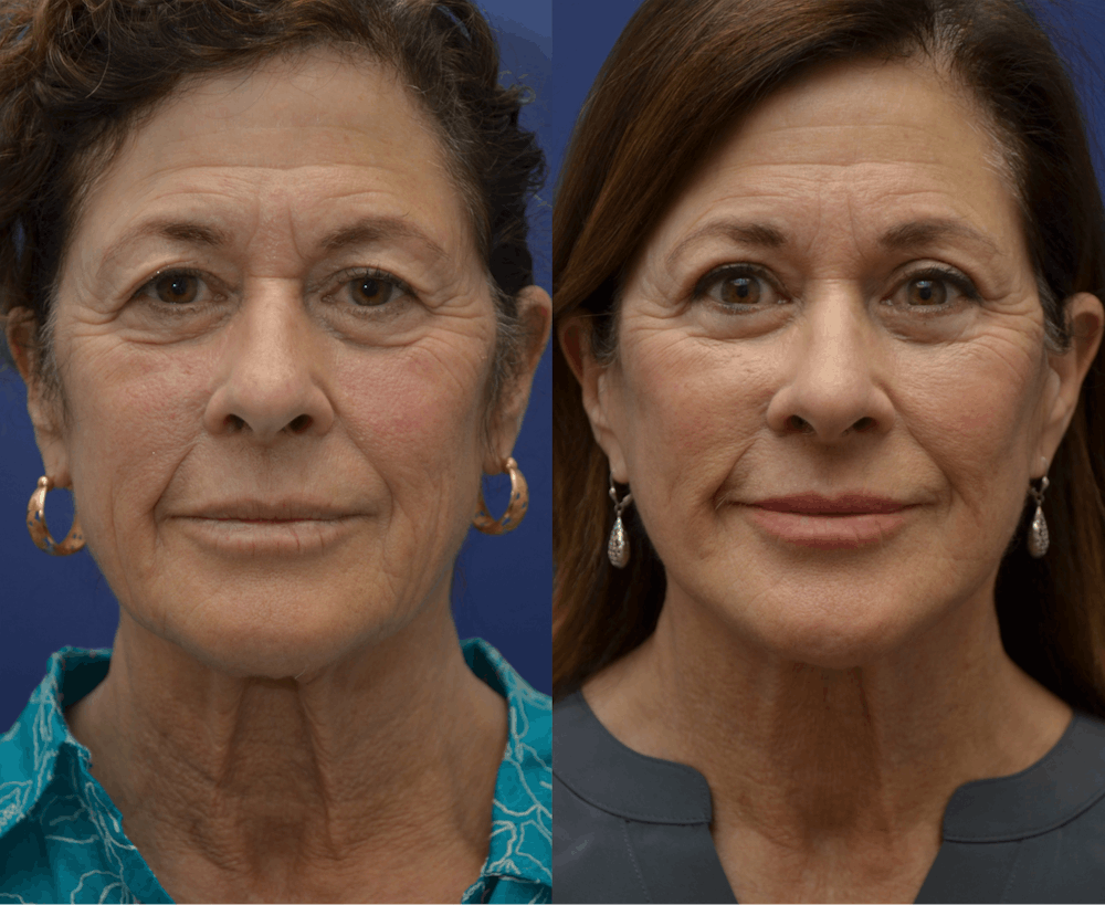Deep Plane Neck Lift Before & After Gallery - Patient 334077 - Image 5