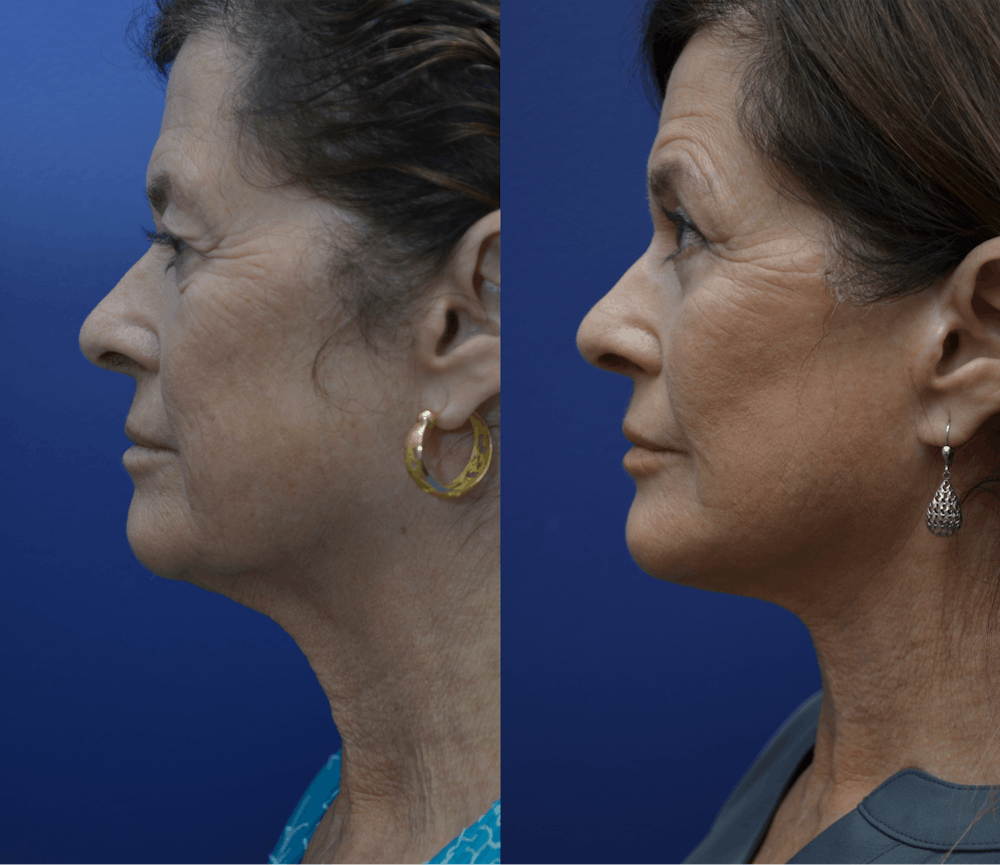 Deep Plane Facelift Before & After Gallery - Patient 298672 - Image 4