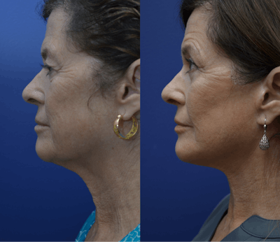 Deep Plane Facelift Before & After Gallery - Patient 298672 - Image 4