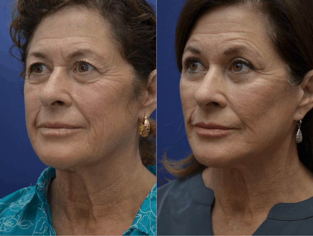 Deep Plane Facelift Before & After Gallery - Patient 298672 - Image 5