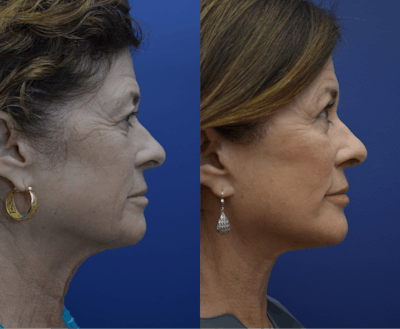 Deep Plane Neck Lift Before & After Gallery - Patient 334077 - Image 2