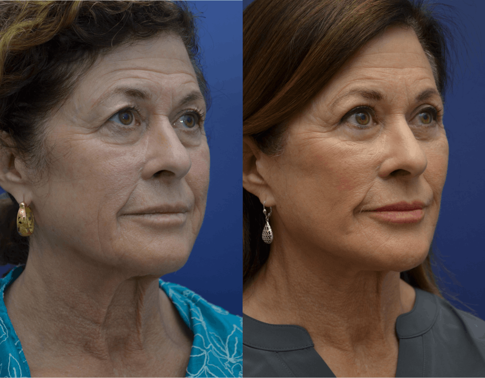 Deep Plane Neck Lift Before & After Gallery - Patient 334077 - Image 1