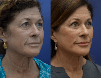 Deep Plane Neck Lift Before & After Gallery - Patient 334077 - Image 1