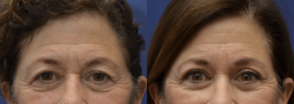 Brow Lift (Forehead Lift) Before & After Gallery - Patient 399334 - Image 1