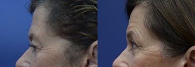 Brow Lift (Forehead Lift) Before & After Gallery - Patient 399334 - Image 2